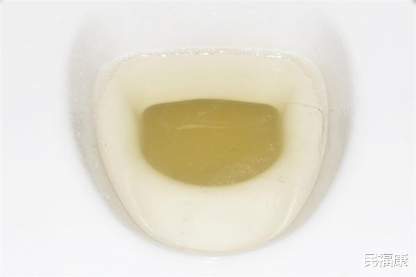 |肾脏不太好的男人，早起后排出的第一泡尿，可能会出现三种异常