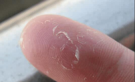 「皮炎」手指“脱皮”,以为是手太干吗,那是身体发出的求救信号!