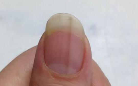 『消化系统』指甲上出现竖纹，是不是身体不健康的表现？听听医生的答案！