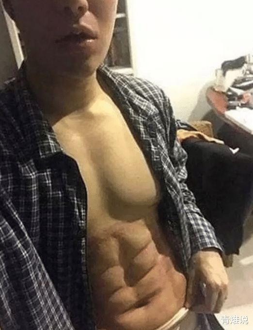 『』当年那个练不出腹肌的小伙，决定做手术填充8块“腹肌”，如今变成怎样了？