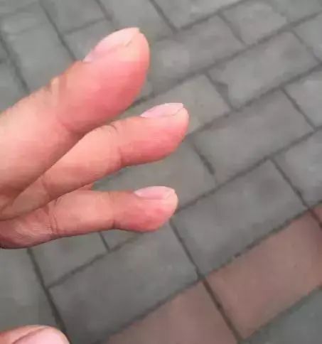 『肝脏』43岁男子，查出肺癌，提醒：手上3种异常，及时查肺！