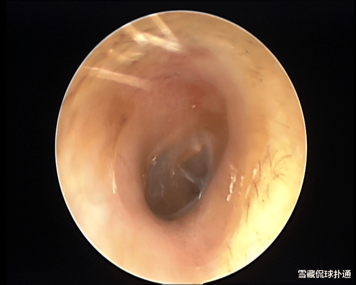 饮食|小伙享受了次掏耳朵服务，可怕一幕出现：耳朵里布满密密麻麻的…