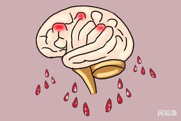 脑出血|血压135/95，伴随头疼，会不会发生脑出血？医生告诉该怎么做