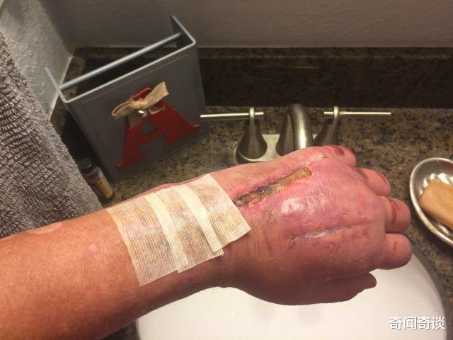 帅哥|英国帅哥割破手,感染罕见食肉菌,看着自己的手被吃掉