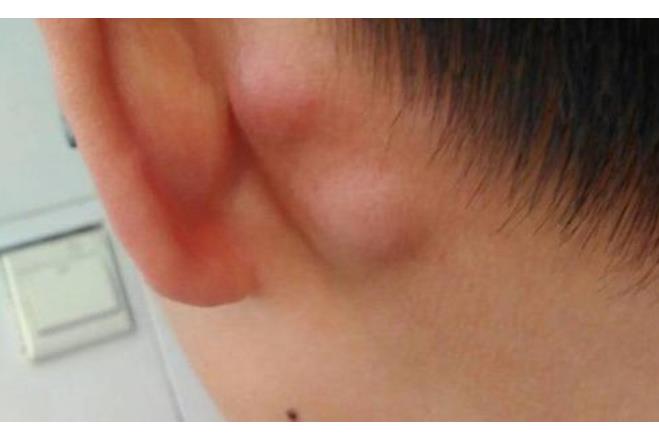 肿瘤|脖子出现这3种表现,可能是患癌的信号,很多人却没当回事!