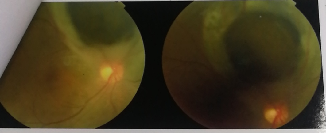 福州晚报|警惕！福州女子确诊“眼癌之王”，最终摘除眼球！只因……