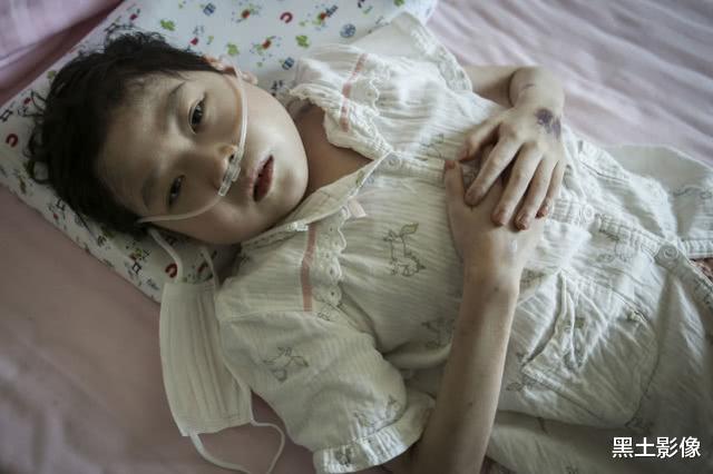 小姐姐▲湖北9岁女孩肺部“薄如纸片”体重仅有22公斤,胳膊腿瘦如柴火棍