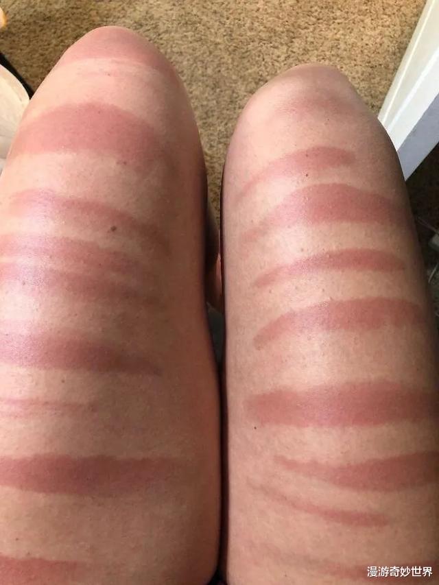防晒|25个被晒伤的惨痛经历，好可怜但又忍不住想笑哈哈哈！