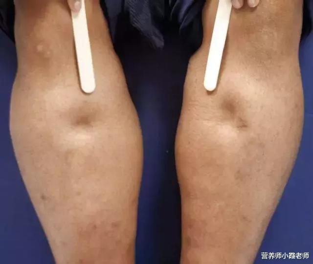 痛风|立秋后，痛风者出现4种迹象，或是肾脏受损了，劝你及时去查一下