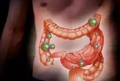 肠癌|不想得肠癌，四件事少做，三样东西少碰，肠道干净，人长寿