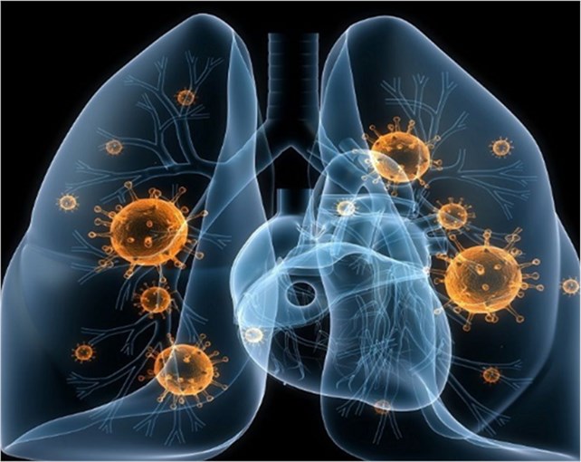 『』肺癌早期的体征与常见表现