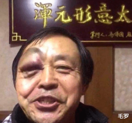 ko■马保国被KO后面部照曝光，网友：你比一龙强，对手可能受了内伤