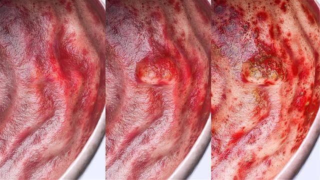 胃癌|49岁大叔腹痛难忍，确诊晚期胃癌，医生叹息：这个部位痛就不该忍