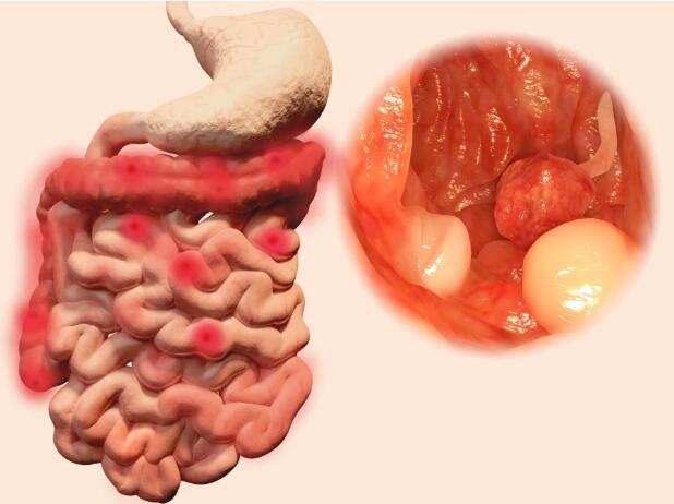 肠癌|排便时大便变细了,就是肠癌?未必,这几个因素,很多人不清楚