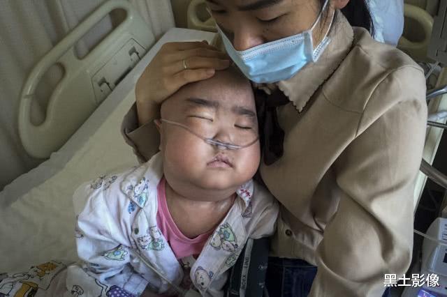 抗癌@7岁“小萝莉”患重症4年样貌大变,今被医生禁食3个月瘦成皮包骨