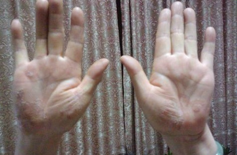 『肝硬化』手长期湿漉漉的会有什么危害