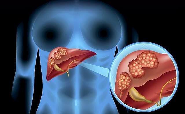 肝脏|不管你是否喝酒，睡觉时若出现3个情况，建议你查一下肝脏