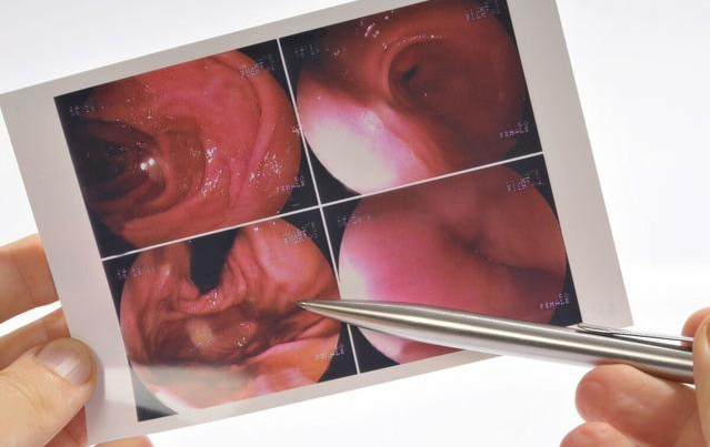 胃癌|38岁女子确诊胃癌，半年后离世，提醒：这些食物少吃，伤胃不浅