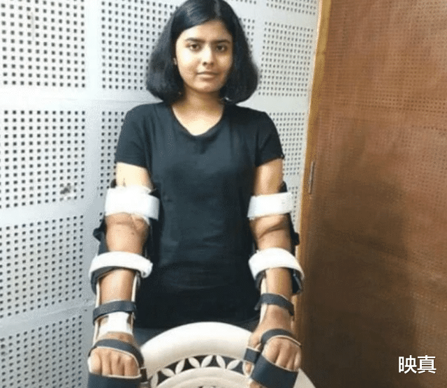 印度女孩失去雙臂後，移植瞭黑人的手臂，2年後皮膚開始變黑-圖4