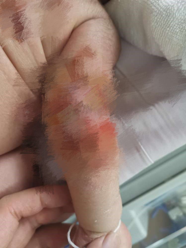 半岛都市报|心疼!出生3天男婴被护士烫伤,愁人!父母欲出国治疗犯难