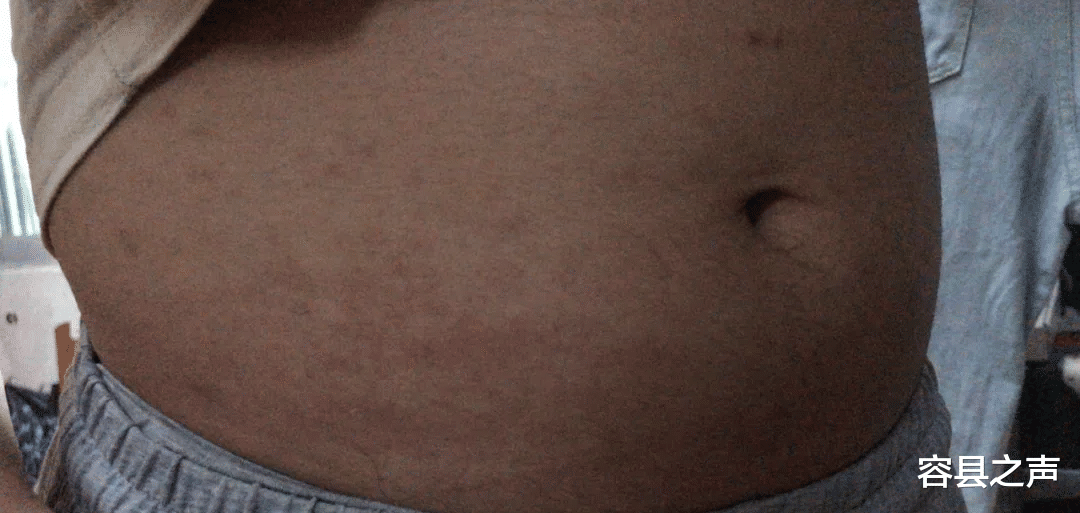 容县之声|广西一学校宿舍出现叫不出名的咬人虫子，闹得人痒痒