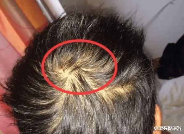 「脱发」肾功能“稀烂”的男孩子，头部“3异象”贼明显，一个不中恭喜咯！