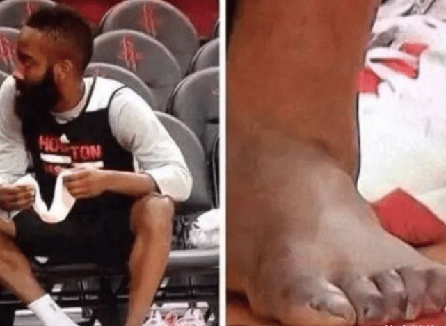 [詹姆斯·哈登]想要成功有多难？哈登脚趾严重变形，停赛还坚持锻炼，太不容易了