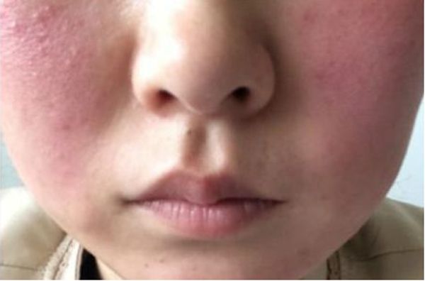 血糖|血糖高的人，脸上若没有这4个“信号”，恭喜你！身体可能还不错