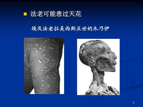 [种族屠杀]新冠长期存在？莫怕“人类史上最大的种族屠杀”病毒半世纪前完败