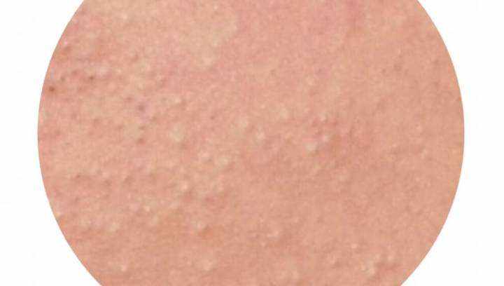 粉刺|痘痘护理之闭口粉刺怎么办？出油长粉刺的人看过来