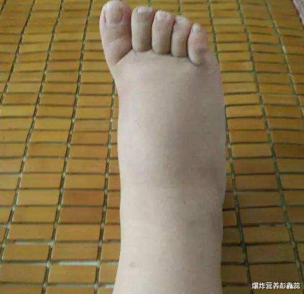 痛风|每3个痛风的人就有1个肾不好，当你出现3种情况，说明肾受伤了