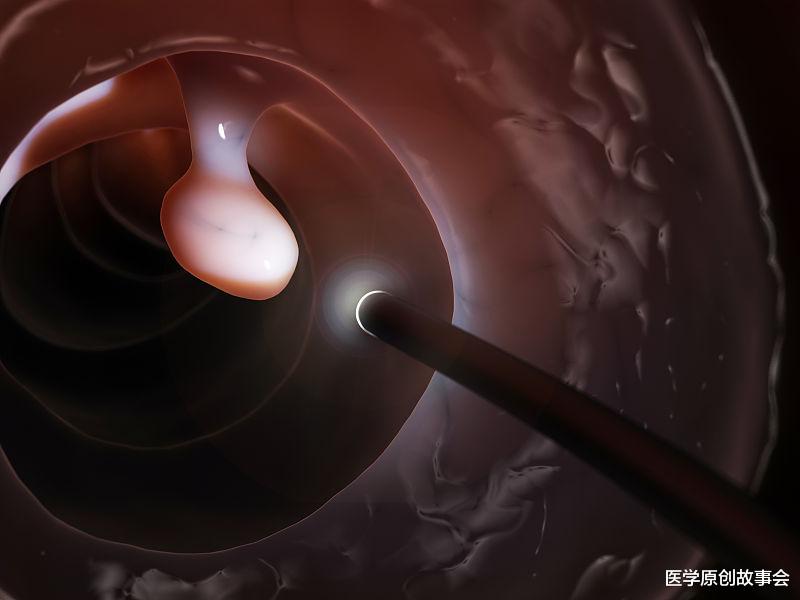 运动|这两个部位如有息肉，一定要及时切除，时间久了容易发生恶变