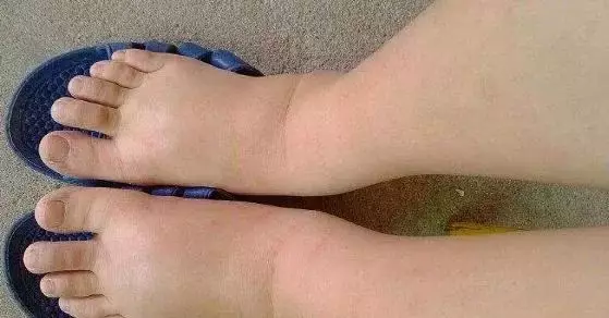 尿毒症@内科主任,一天排尿接近“这个数”,尿毒症可能离你还很远,不妨自测