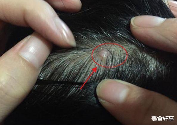 痛风|头皮里的“小疙瘩”是什么?可能已经被这3种病缠上身,无视后悔
