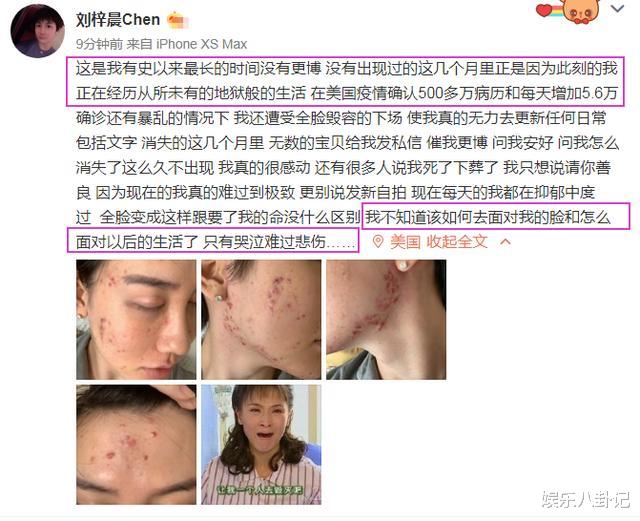 刘梓晨|网红刘梓晨时隔多日发文正在经历地狱般生活,全脸毁容,非常难过