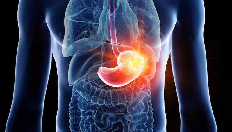 幽门螺旋杆菌|感染了幽门螺旋杆菌，这4种食物真要少吃了，否则细菌超标很伤胃