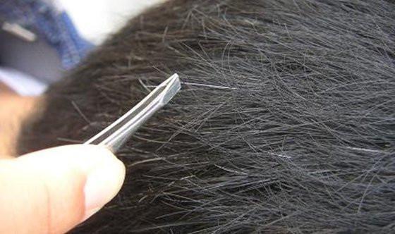 『白发』白发在前额、两鬓、后脑勺,各自暗示什么?医生给你进行解答!