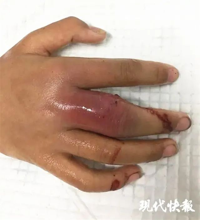 福州■可怕！福州男子感染“吃人肉细菌”，只因……