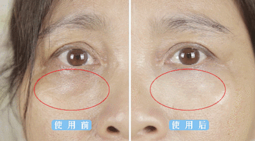 黑眼圈|药店有一种不起眼的乳膏，堪称眼袋黑眼圈“天敌”，却因廉价被嫌弃！