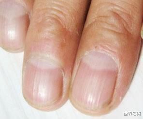 ##人体出现这样的指甲，要当心身体病变