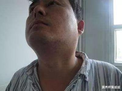 [经络]肺不好，会出现“1慢、2凸、3多”，若没有，说明肺部还算健康