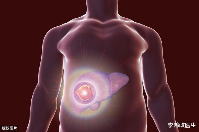#肝癌#58岁男子胸闷胸痛,后诊断肝癌,普通人如有这个检查异常,要注意