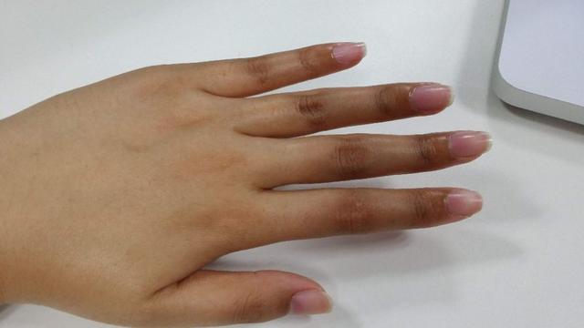 |身体患癌，这些部位会变黑，早发现早治疗，你知道是哪些部位吗？