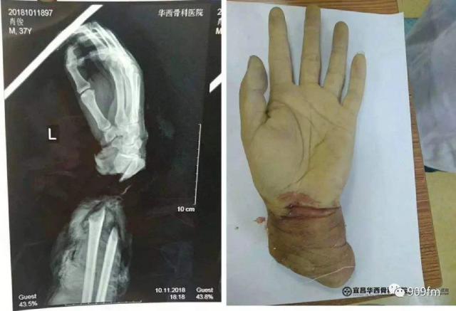 半岛晨报|是个狠人！22岁姑娘锯断手骗保