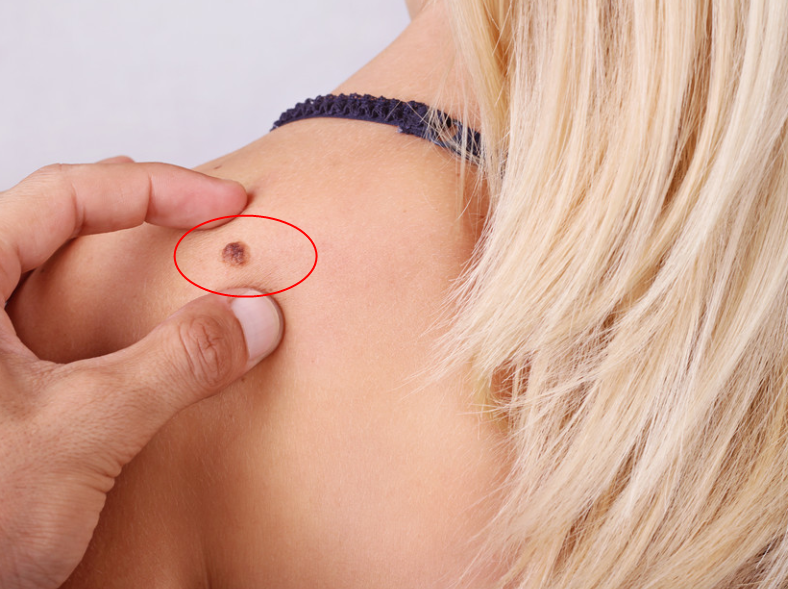 『糖尿病』肝不好的人，脸上会出现3个“不舒服”，别不当回事