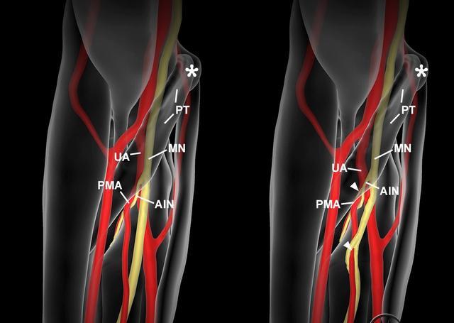 科学家|谁说人类已停止进化？你身体里可能已多出一条动脉，而且进化神速