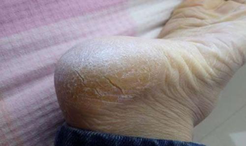 【】经常脚后跟干裂是啥情况？别忽略，其实是身体在“提醒”你