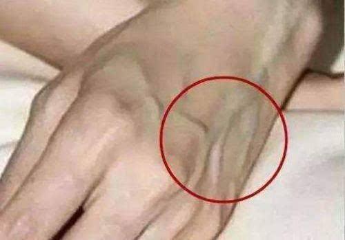 皮肤瘙痒■肝内藏毒，手先知，手上若出现4个变化，提示你要排肝毒了