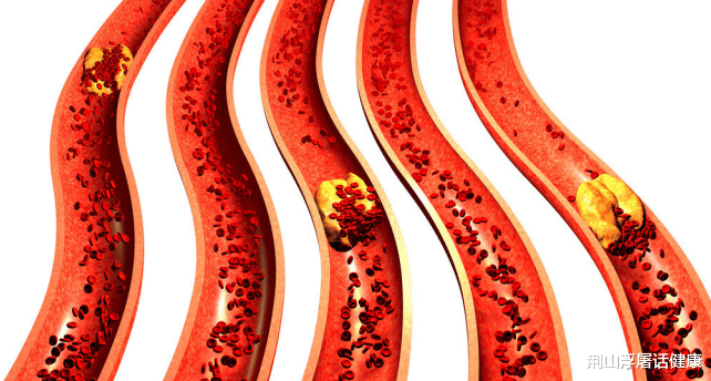 洋葱|血管“清道夫”被发现，不是洋葱和猪血，平时放开喝，血管不堵了
