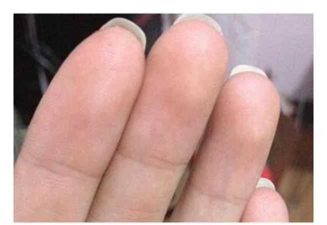 【长寿】手指上的簸箕与斗跟寿命有关？是科学还是迷信？医生说出实话！